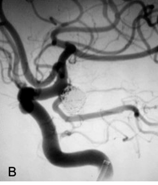 Catheter angiogram after coiling showing the aneurysm no longer filling