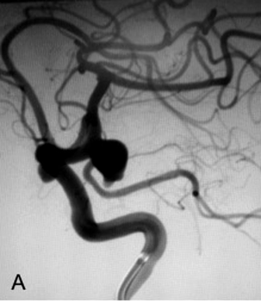 Catheter angiogram showing an aneurysm filling with contrast before treatment