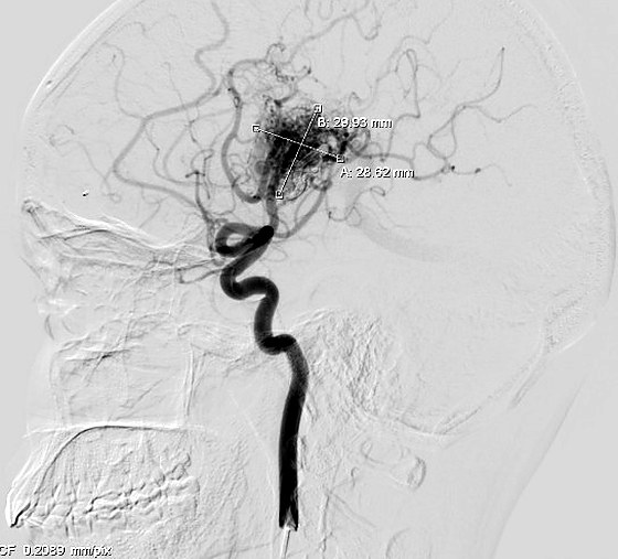 Angiogram with the malformation measured for treatment planning