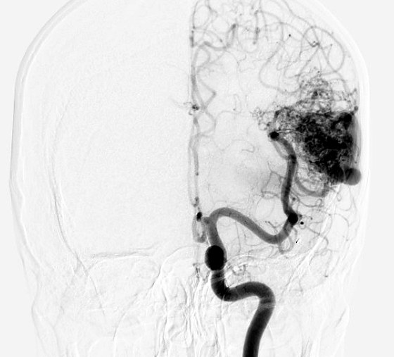 Catheter angiogram showing the tangle of vessels of a brain arteriovenous malformation