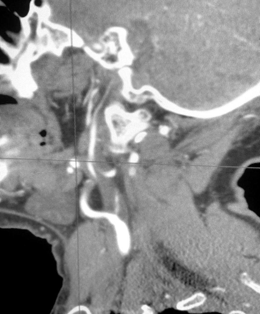 CT angiogram section through the carotid artery