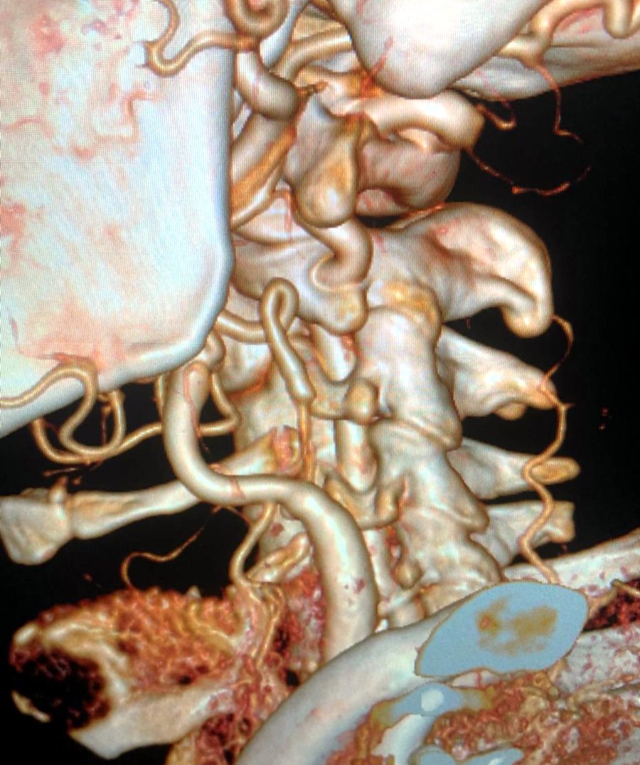 Three-dimensional CT angiogram reconstruction of the neck arteries