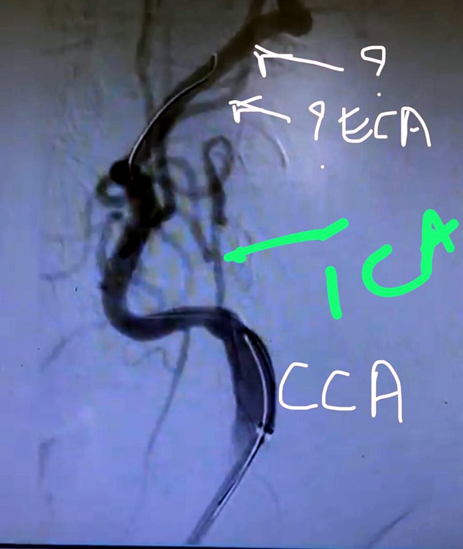 Catheter angiogram with the common, internal and external carotid arteries labelled