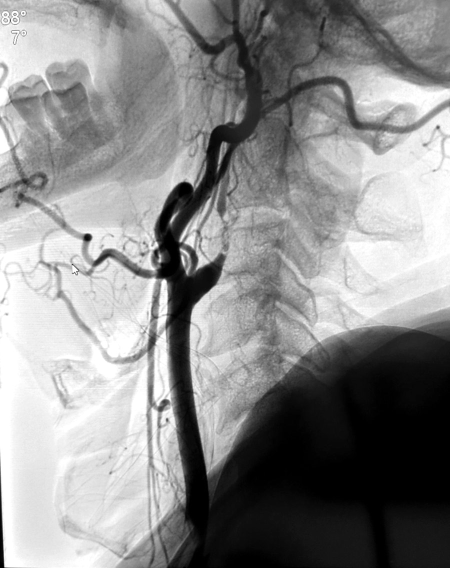 Catheter angiogram of the carotid artery in the neck