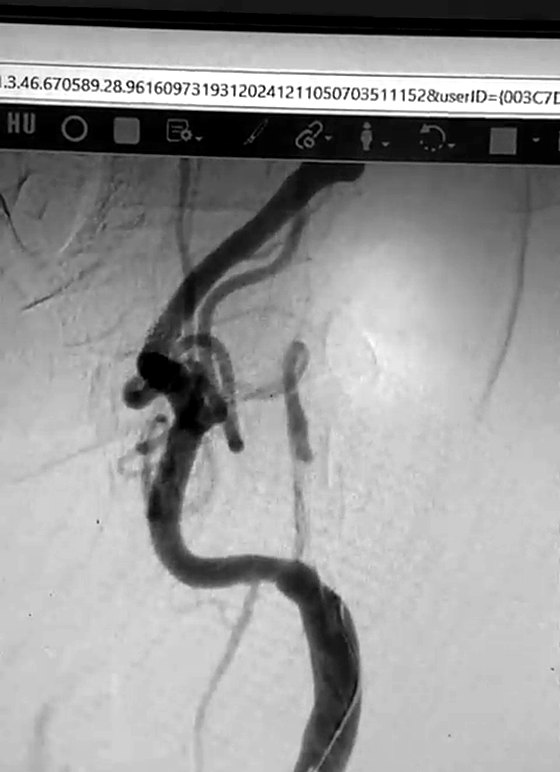 Angiogram after carotid stent placement showing restored flow