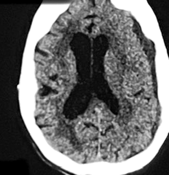 Follow-up CT scan showing the collection resolved