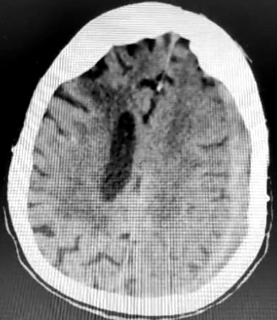 CT scan showing a chronic subdural collection compressing the brain