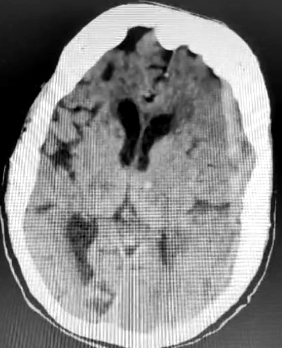 CT scan at a higher level showing the same subdural collection