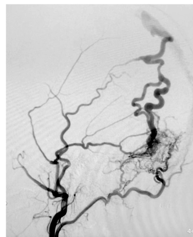 Catheter angiogram showing a dural arteriovenous fistula before treatment