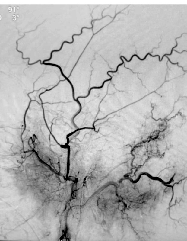 Angiogram during transarterial embolisation of the fistula