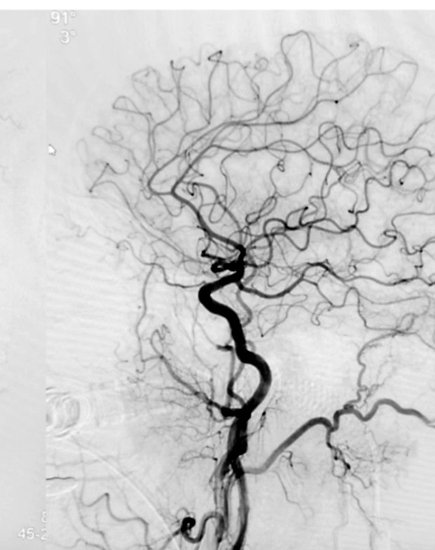 Angiogram after embolisation showing the fistula closed