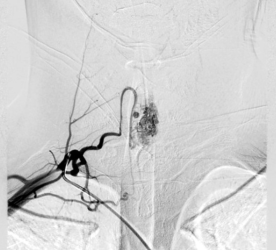 Spinal angiogram showing an arteriovenous malformation of the spinal cord