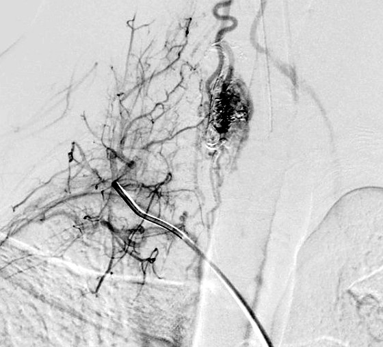 Spinal angiogram with a microcatheter positioned in a feeding vessel