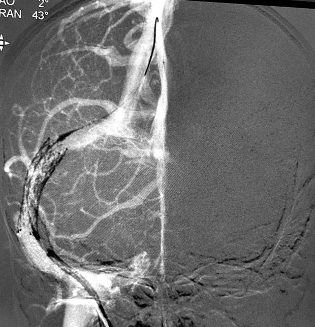 Stent positioned across the narrowed venous sinus