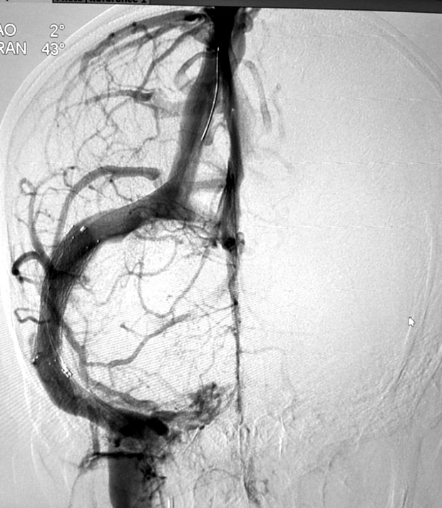 Venous phase angiogram after venous sinus stenting
