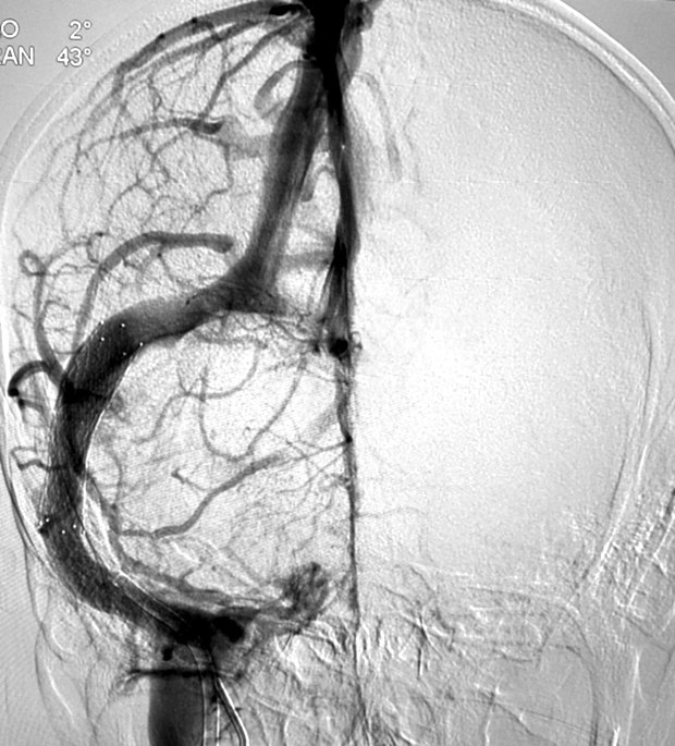 Venous phase angiogram of the transverse and sigmoid sinuses